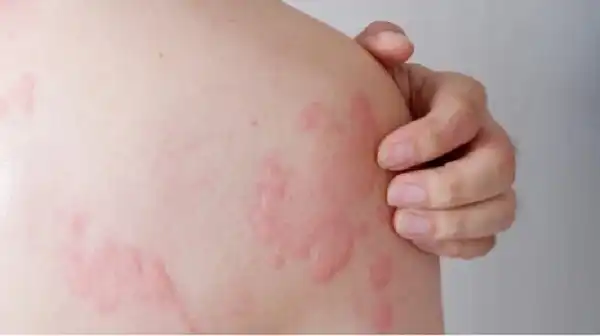 Dấu hiệu ung thư gan: Những cảnh báo sớm dễ bị bỏ qua nhưng cực kỳ nguy hiểm