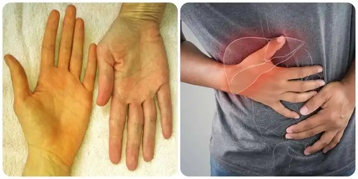 9 DẤU HIỆU UNG THƯ GAN KHÔNG THỂ BỎ QUA